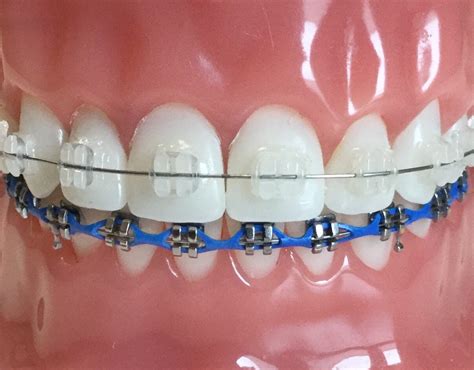 metal brackets vs ceramic brackets|ceramic braces cost per month.